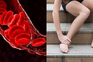 Gydytojas įspėja: tai gali būti ženklas, kad kemšasi kraujagyslės