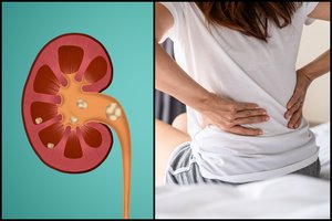 Paaiškėjo kokią klaidą daro žmonės, kuriems išsivysto inkstų akmenligė