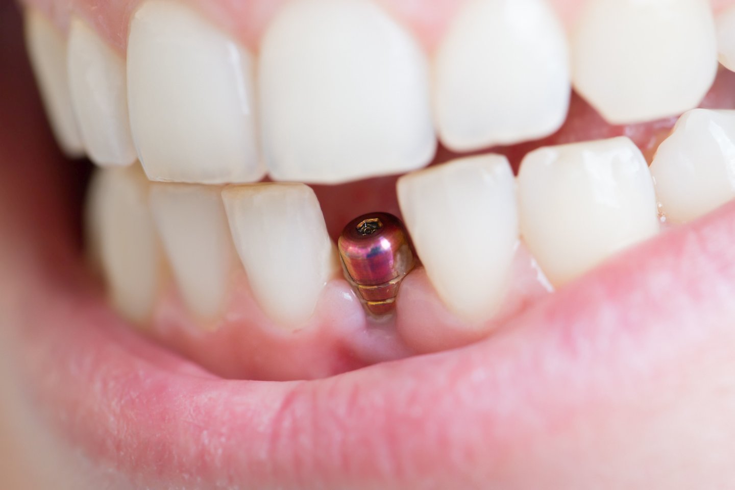 Turintiems dantų implantų ar karūnėlių ypač atsargiai reikėtų naudotis tarpdančių siūlu – geriausia vietoj jo rinktis irigatorių.<br> 123rf nuotr.