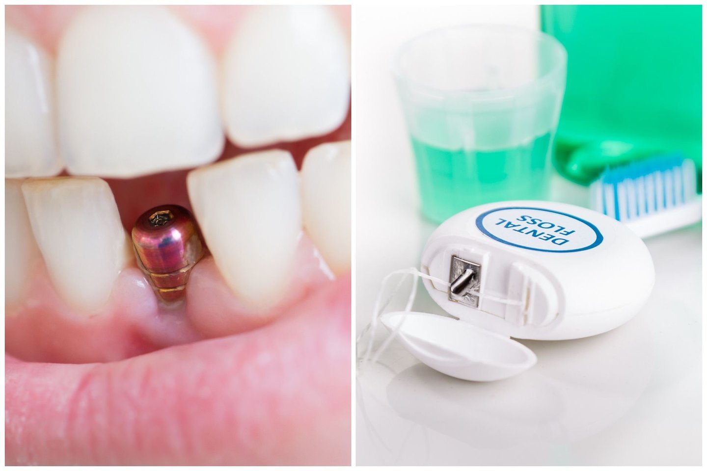 Turintiems dantų implantų ar karūnėlių ypač atsargiai reikėtų naudotis tarpdančių siūlu – geriausia vietoj jo rinktis irigatorių.<br> 123rf nuotr.