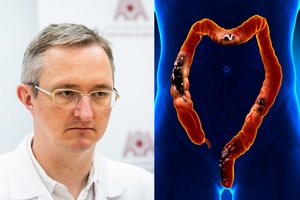 Gydytojas pasakė, kam gresia storosios žarnos vėžys: nesunkų testą atlikti namie gali visi