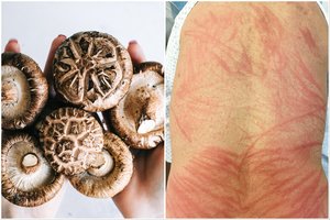 Pavalgius grybų – tarsi bizūnu sučaižyta nugara: paslaptį padėjo atskleisti ir lietuvė mokslininkė