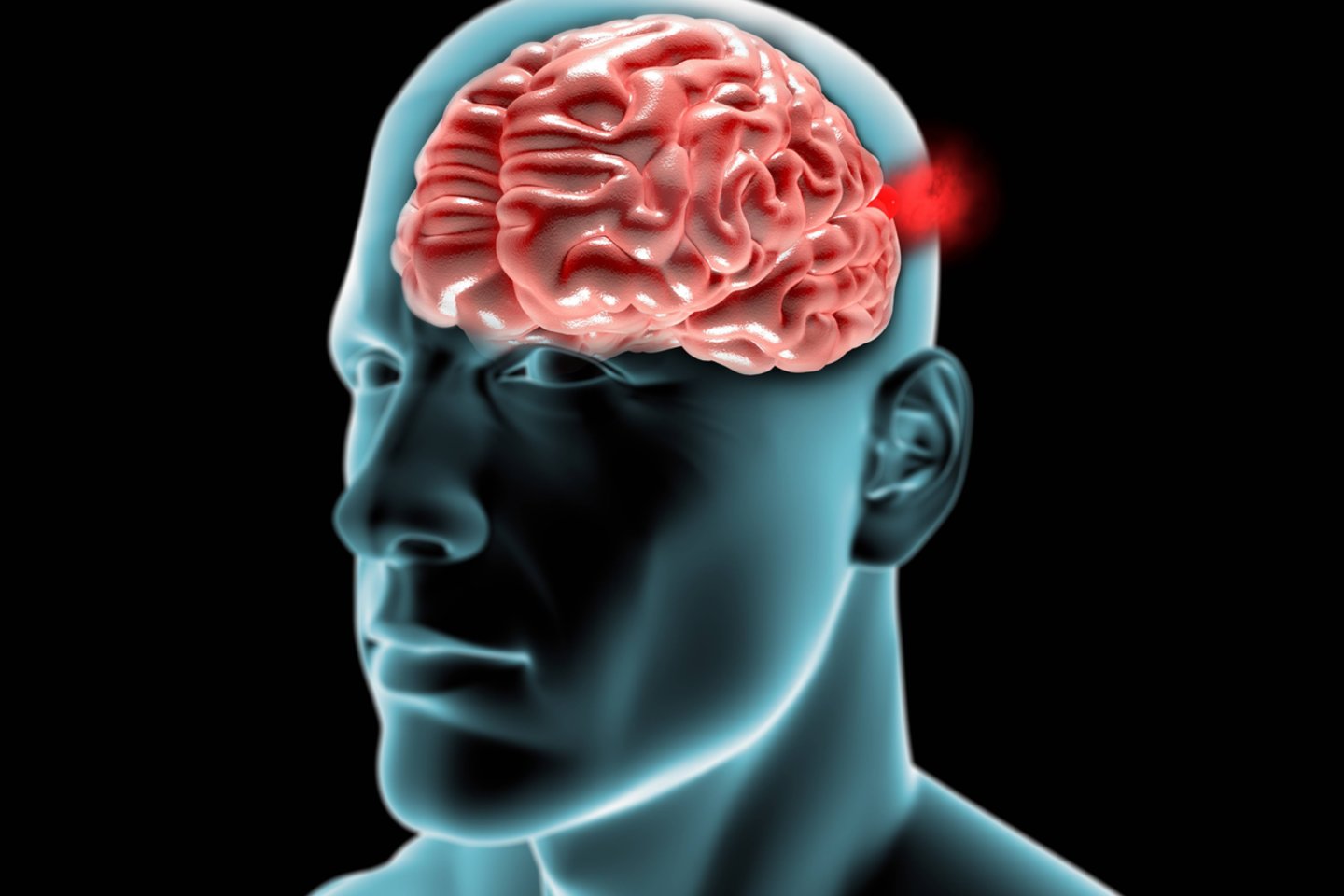 Galvos smegenų aneurizma<br>123rf iliustr.