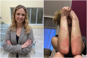 24-erių Eva jautė gėdą dėl klastingos ligos: išgelbėjo medikės pasiūlymas