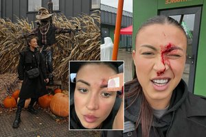 Apsilankymas siaubo parke E. Jakštytei baigėsi rimtu sužeidimu: veidas pasruvo krauju