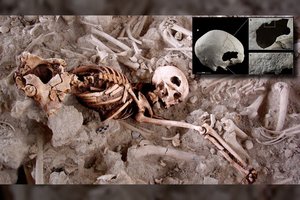 Neįtikėtina: prieš 4500 moteris ištvėrė dvi kaukolės operacijas – ir jas išgyveno