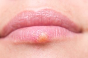 Atsiradus lūpų pūslelinei pataria vengti fizinio kontakto – užkrėsti galima net ir namiškius