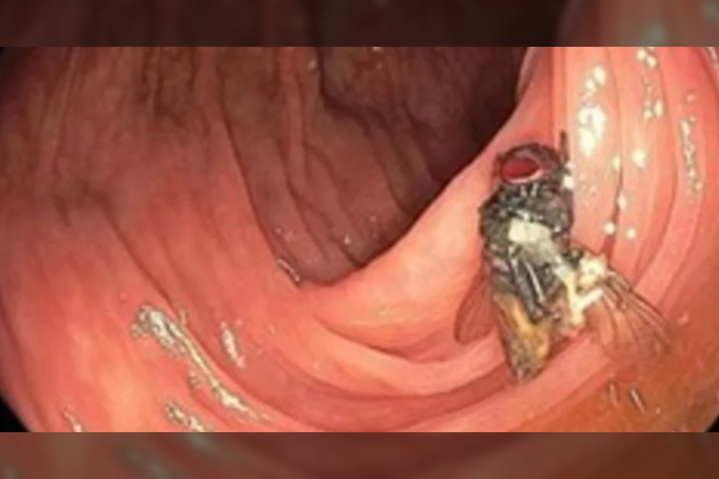 Kolonoskopijos nuotraukoje matyti nepažeista musė vyro storosios žarnos viduje.<br>The American Journal of Gastroenterology nuotr.