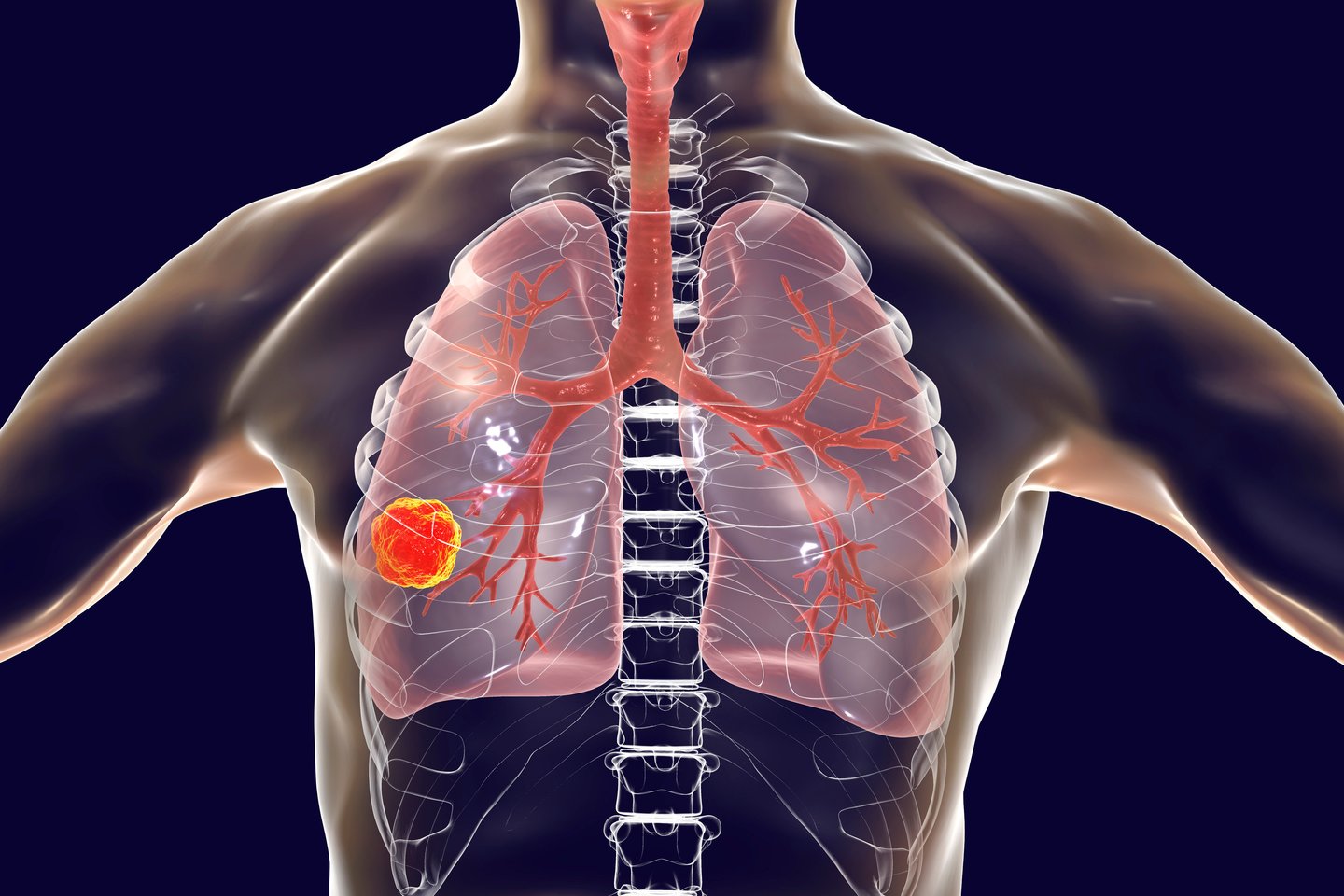  Naujų tyrimų rezultatai rodo, kad dirbtinio intelekto programa gali nustatyti, ar nerūkančiam žmogui yra didelė rizika susirgti plaučių vėžiu, išnagrinėjusi vos vieną rentgeno nuotrauką.<br> 123rf iliustr.