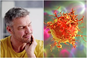 Įsidėmėkite: šie simptomai gali išduoti burnos vėžį