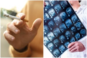 Ištyrė rūkančių žmonių smegenis: matomi baugūs pokyčiai