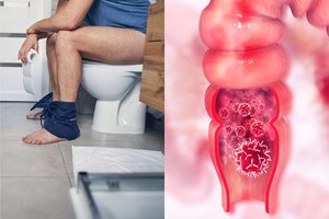 5 požymiai, kurie gali byloti apie vėžį – privalote pasitikrinti