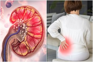 Šis simptomas išduoda inkstų akmenligę – dažnas jį pražiopso