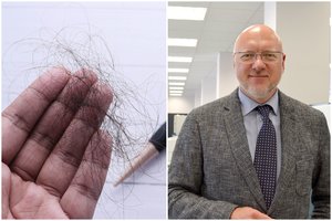 Gydytojas įspėja: sausa oda ir plaukų slinkimas išduoda svarbaus organo sutrikimą