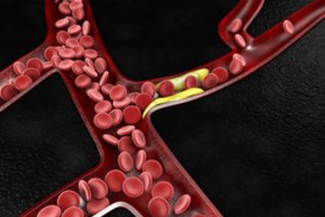 Paaiškėjo, kad cholesterolio kiekiui mažinti naudotas vitaminas prišaukia širdies ligas