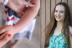 Psichosomatikos specialistė: vaikų odos ligos gali kilti ne dėl medicininių priežasčių, o dėl to, kas mūsų galvose