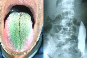 Nuo samanų ant liežuvio iki voro ausyje: keisčiausi metų medicinos atradimai