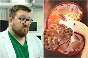 Norite išvengti inkstų akmenų? Gydytojas turi svarbų patarimą