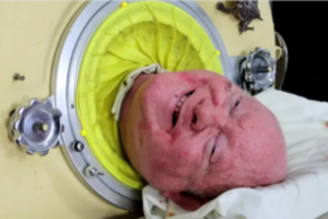 72 metai kapsulėje: ypatinga „žmogaus su geležiniais plaučiais“ istorija