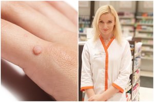 Vaistininkė patarė, kaip naikinti karpas: veiksmingiau nei visi liaudiški metodai