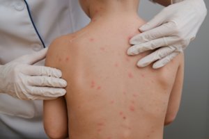 Vėjaraupiai gali sukelti sunkias komplikacijas – jų išvengti padeda skiepai