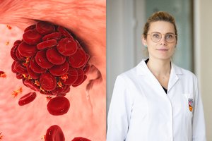 Gydytoja išvardijo, kokie ženklai išduoda krešulį plautyje – delsti negalima