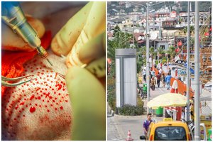 „Plaukų fabrikai“: protu sunku suvokti, kas dedasi lietuvių pamėgtoje atostogų šalyje – siaubo istorijos ir baisūs randai