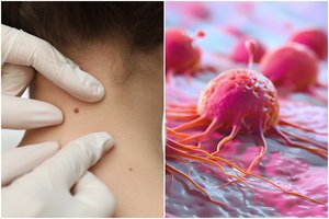 Vėžys vystosi, o skausmo nėra: profesorė išvardijo, kurie požymiai negali praslysti pro akis