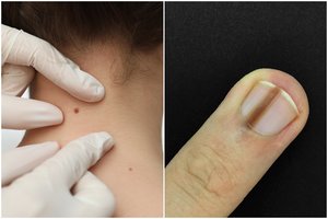 Odos vėžį išduoda ne tik apgamai: gydytoja pasakė, kada delsti negalima