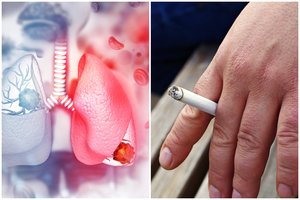 Paaiškėjo, kaip sumažinti tikimybę susirgti plaučių vėžiu: rūkymas – ne vienintelis nuodas