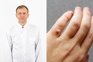 Niekaip nepavyksta pašalinti karpos? Gydytojas turi atsakymą