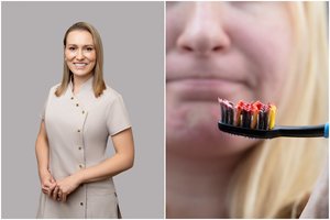 Klastinga liga, kuria serga daugelis: išduoda kraujuojančios dantenos ir „pailgėję“ dantys