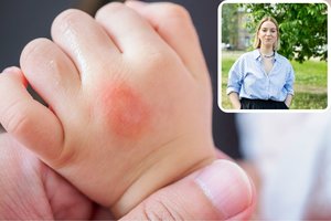 Apie vabzdžių įgėlimų vaikams poveikį L. Suodaičiui aiškinusi gydytoja: netrukus bus vakcina ir nuo Laimo ligos