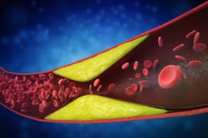 Tyrimas parodė, koks maistas kemša kraujagysles: ragina įsidėmėti svarbią taisyklę