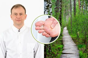 Gydytojas sako, kad karpas išnaikinti galima nuėjus į mišką: „Visai gerai sekasi“