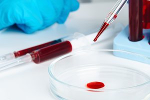 Hemofilija: gydytoja paaiškino, kodėl liga dažniau pasireiškia vyrams nei moterims