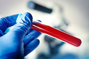 Kraujo tyrimas gali beveik be klaidų diagnozuoti Alzheimerio ligą