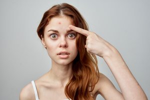 Vasarą ant veido odos padažnėja spuogeliai? Sužinokite, kodėl taip yra
