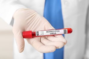 Staigus beždžionių raupų plitimas pastatė pasaulį ant kojų: štai kas žinoma apie virusą