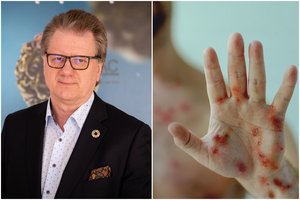 Kokią žinią siunčia beždžionių raupų protrūkis? Profesorius įžvelgė panašumą su virusu, kuris šiurpino pasaulį