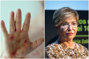 R. Lingienė patarė, kaip neužsikrėsti beždžionių raupais: „Tikiuosi, kažkam pravers“