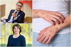 Ekspertai apie beždžionių raupų „gaisrą“: didžiausia baimė – koronaviruso scenarijus