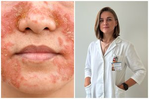 Nemaloni liga nusitaiko į grožį ir kelia nepatogumus: ypač kenčia šių profesijų atstovai ir kolekcininkai