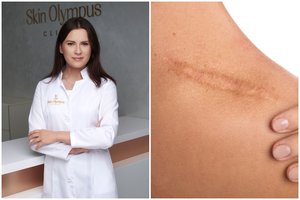 Gydytoja dermatovenerologė: 3 mitai apie randus, trukdantys juos gydyti ir pasiekti norimą rezultatą