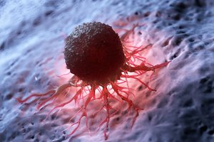 Mokslininkai: štai kuo pasižymintys žmonės turi didesnę tikimybę susirgti vėžiu