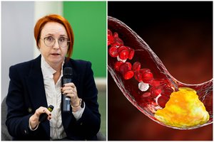 Kardiologai atskleidė, kas „blogąjį“ cholesterolį mažina veiksmingiau nei sveika mityba