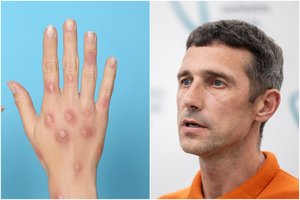 Paaiškėjo daugiau faktų apie Lietuvoje nustatytą „b raupų“ atvejį: užsikrėtęs vyras – turistas iš Ispanijos