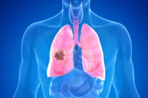 Santaros klinikose pradėta bandomoji plaučių vėžio ankstyvosios diagnostikos programa