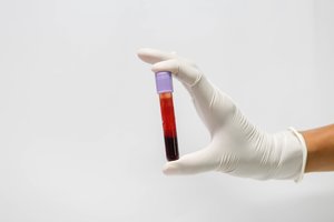 Mokslininkai: turintys šią kraujo grupę turi didesnę riziką patirti ankstyvą insultą