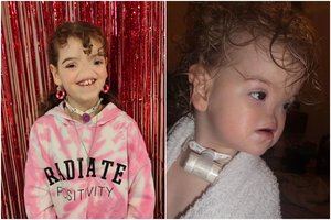 Neįtikėtina stiprybė: be nosies gimusi mergaitė įrodė, kad visi klydo